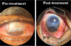 KS Hegde Medical Academy achieves breakthrough in stem cell therapy; corneal patients regain full vision
